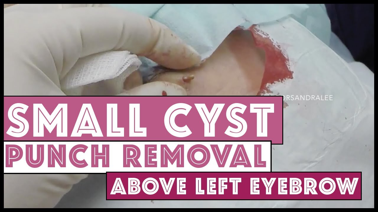 Punch removal of a small cyst filmed with my GoPro