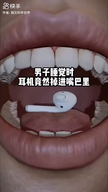 Earphone Stuck in Throat