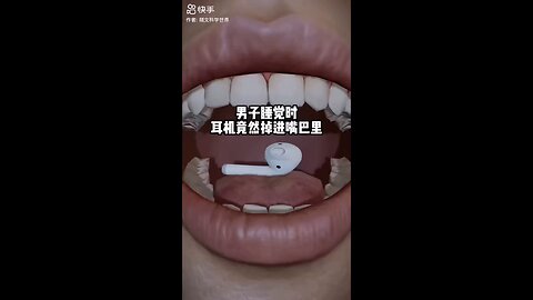 Earphone Stuck in Throat