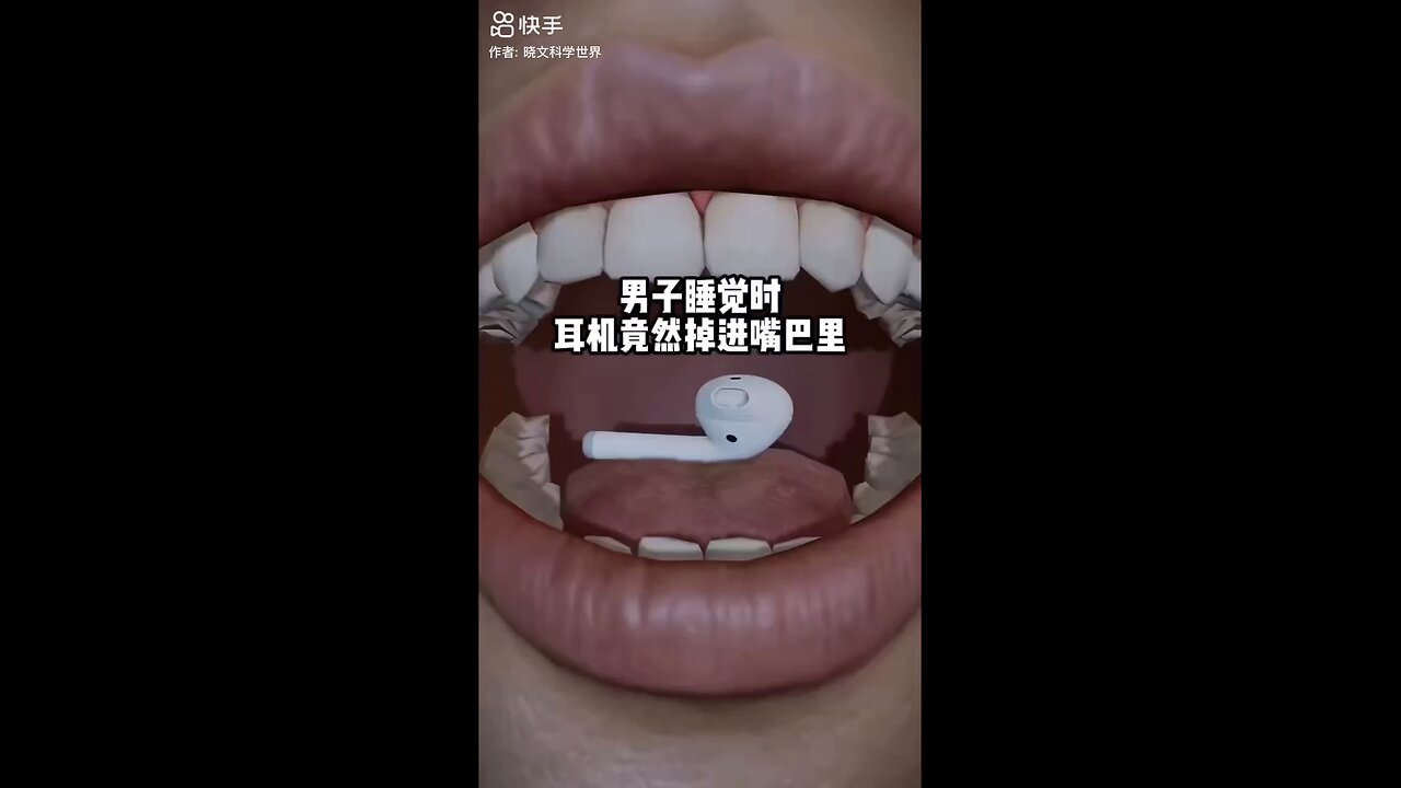 Earphone Stuck in Throat