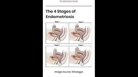 Approaching Endometriosis Naturopathically with Eden’s Living TV
