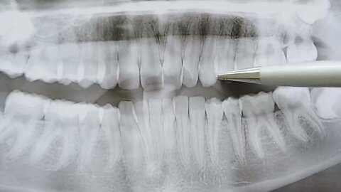 Dentists Say This Inexpensive Ancient Mineral Works Better Than Implants