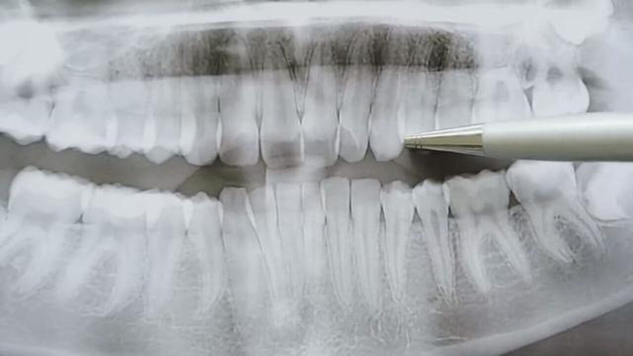 Dentists Say This Inexpensive Ancient Mineral Works Better Than Implants