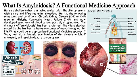 What Is Amyloidosis? A Functional Medicine Approach