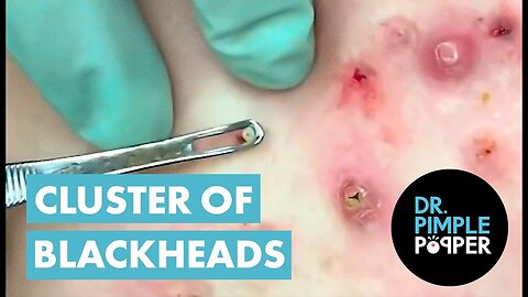 50 Minutes of Blackheads Clusters of Blackheads with Dr Pimple Popper
