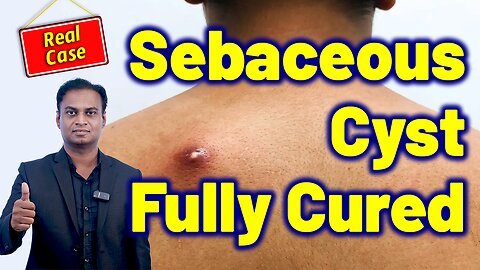 Get Rid of Sebaceous Cyst Without Surgery, Permanent Cure Cyst Removal Treatment. | Relief
