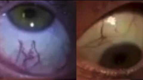 "Discover the Presence of Parasites in Almost Everyone, Especially in the Eyes"