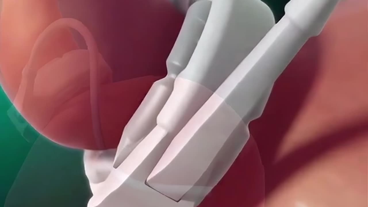 Gastric Band Surgery (3D Animation)