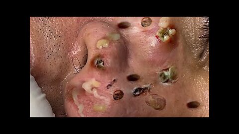 blackhead removal and Pimplepopper Spa relaxation #10126