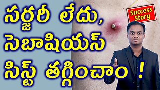 సర్జరీ లేదు, సెబాషియస్ సిస్ట్ తగ్గించాం Cured Sebaceous abscess Cyst without Surgery with Homeopathy
