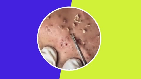Skincare | Blackheads Removal (ASMR) #7 #tweezers #skincare #blackheads