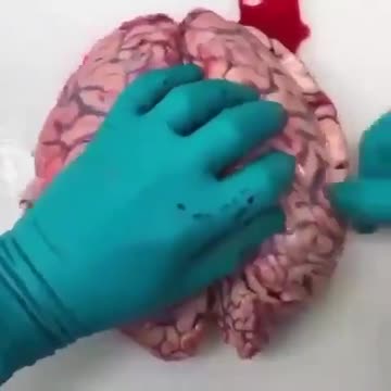 Thromboses in the brains of people killed by vaccine