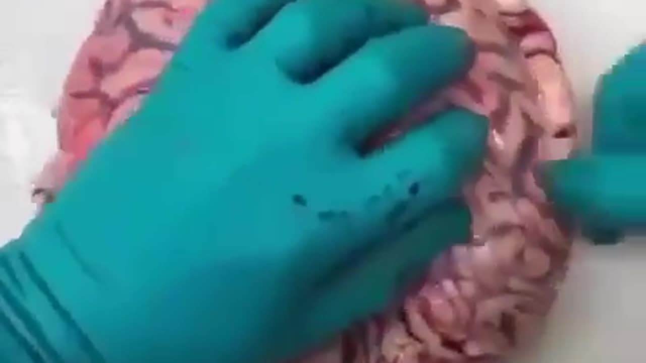 Thromboses in the brains of people killed by vaccine