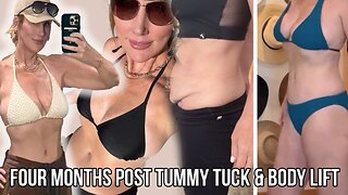 It's Been 4 Months - Tummy Tuck & Body Lift Update