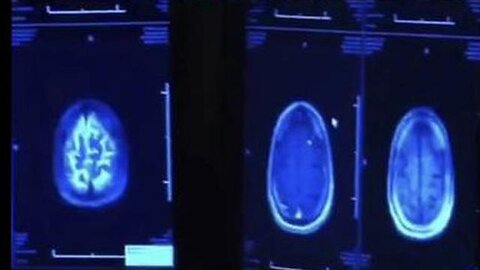 "Understanding the Journey of Aluminum in Your Body Post-Vaccination"
