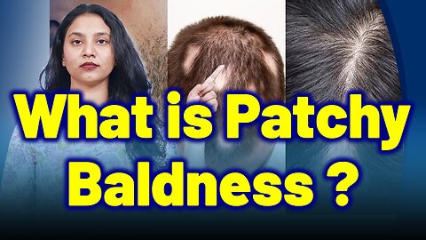 What is Alopecia Areata, Patchy Baldness ?| Treatment Cure Relief Medicine Skin Hair | Homeopathy