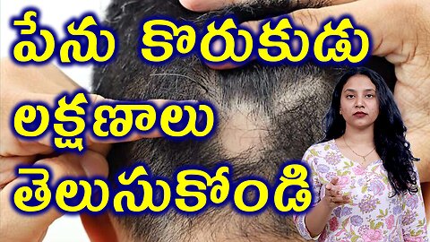పేను కొరుకుడు లక్షణాలు తెలుసుకోండి Signs of Alopecia Areata or Spot Baldness Homeopathy Treatment