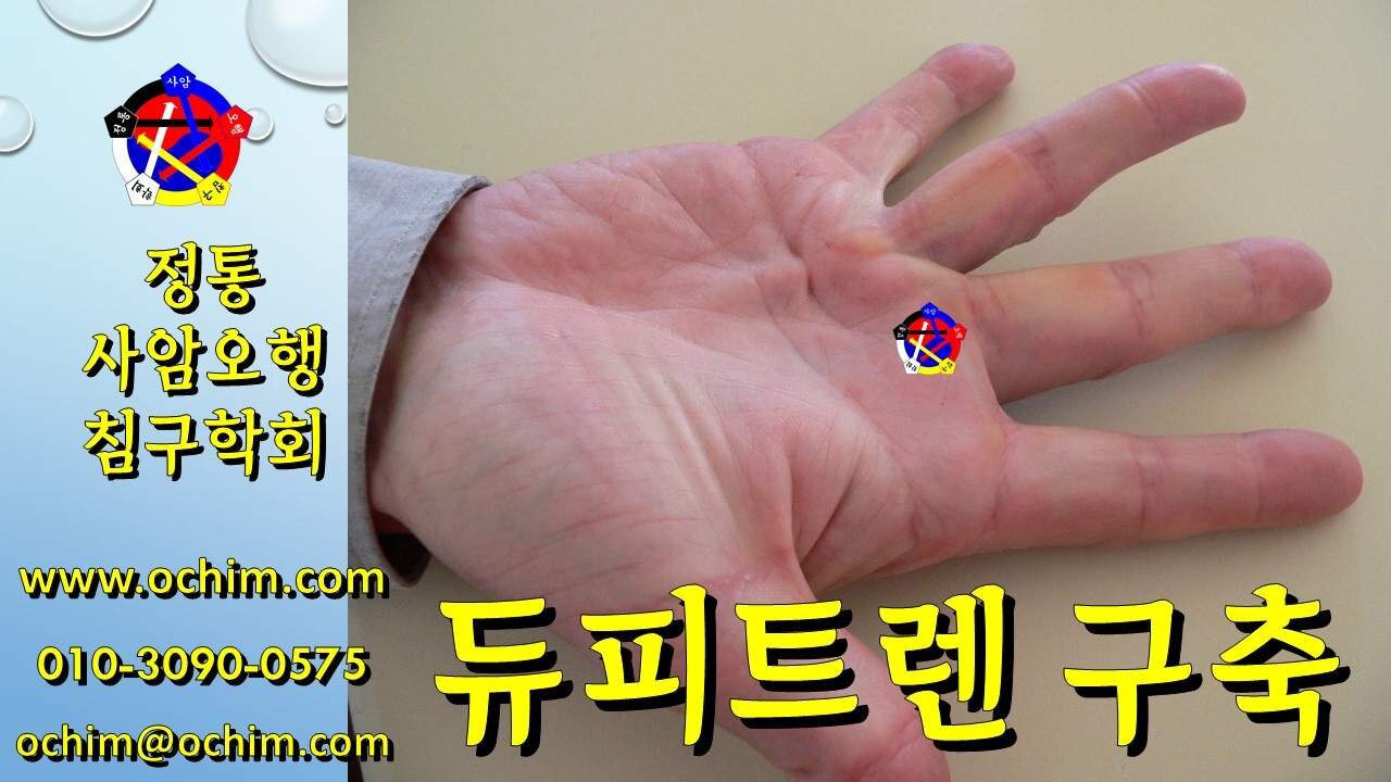 듀피트렌 구축 원인과 치료방법 - 사암오행침, 사암침법, 오행침, 정통사암침