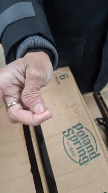 He was drinking, fell up the stairs and landed on his thumb. That looks so creepy!