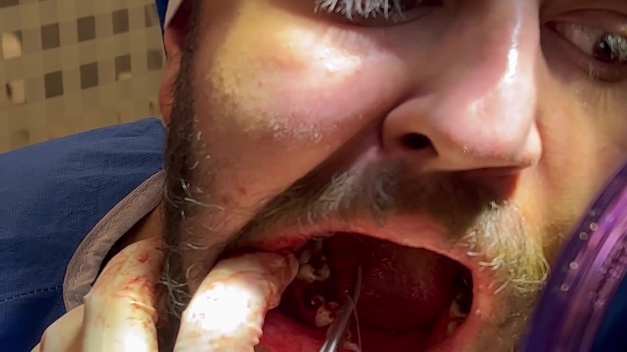 implant in my mouth