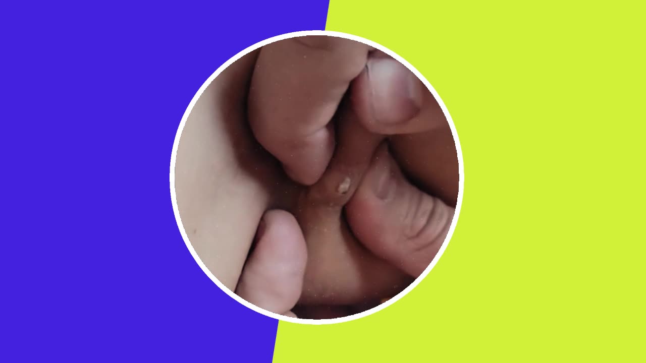 Pimple removal satisfying video (ASMR) #2