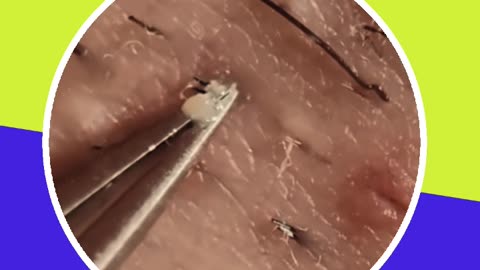 Pimple removal satisfying video (ASMR) #3 #shorts