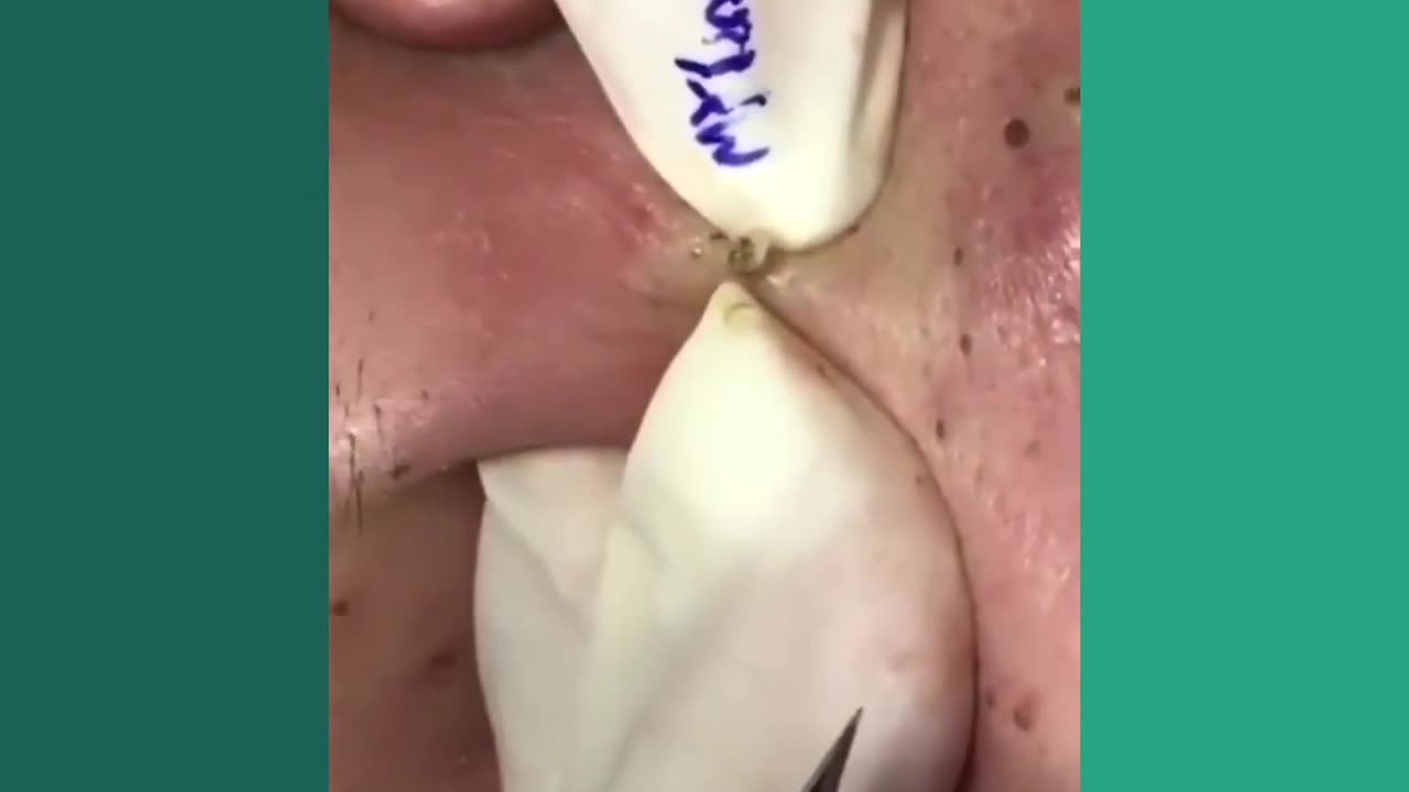 Blackheads Removal & Pimple Popper Cystic Acne Extraction 213