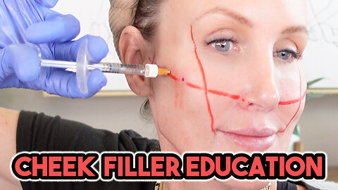 Cheek Filler Education