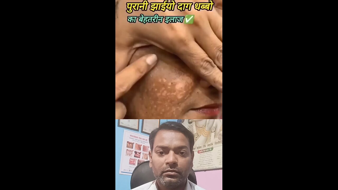 झाइयों का देसी इलाज ।