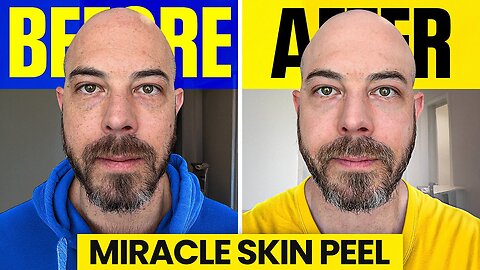 At-Home Chemical Peel That Actually Works! | Dermatologist Review