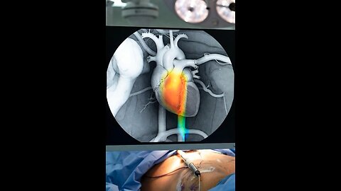 Angiography 3D Animation