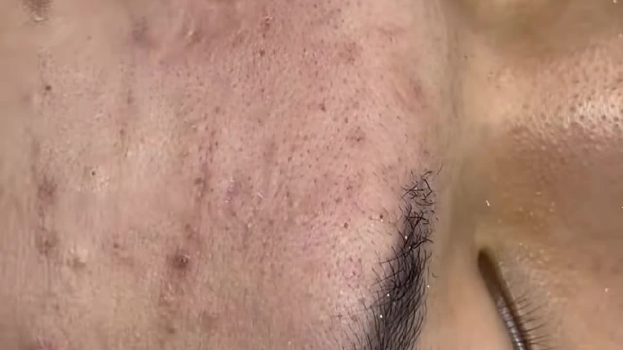 Relaxing Acne Removal Sounds