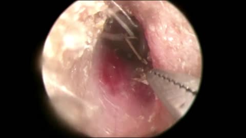 It's not Ear Wax but a GRASS in the ear, How I got it out?