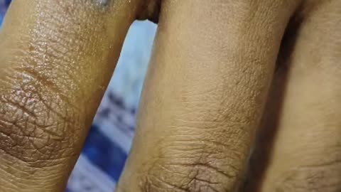Tattoo Removel In Hyderabad At Tiacare