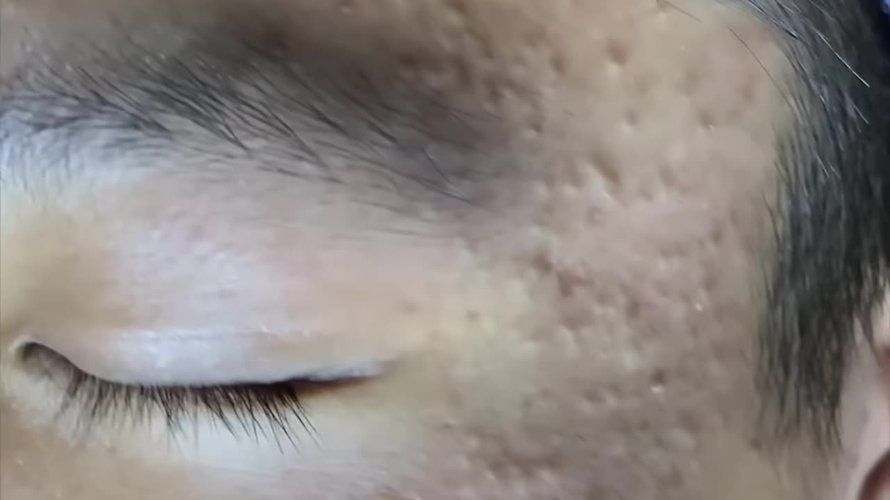 Full video in the comment section #sacdepspa #acne