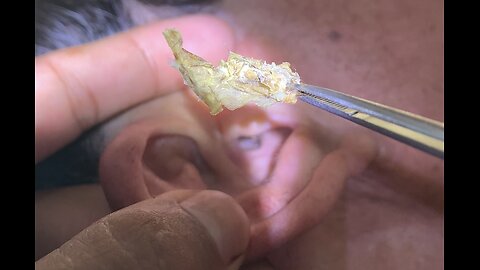 remove earwax
