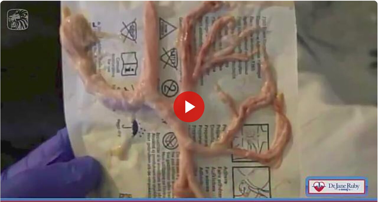 Fibrous clot coughed up by jabbed 32 year old ER patient.