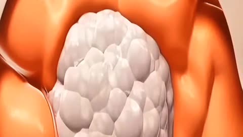 Life-Saving Brain Surgery How Doctors Remove a Tumor Without Damaging the Mind