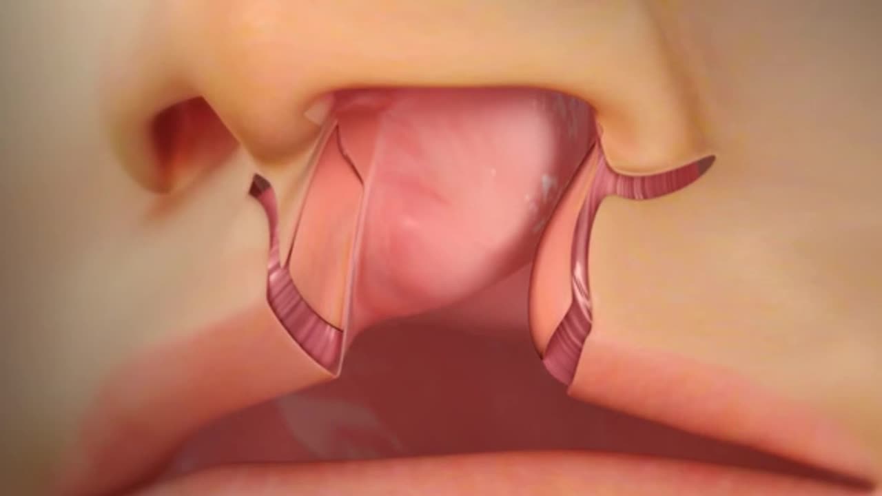 Cleft Lip Repair Surgery 3D Animation