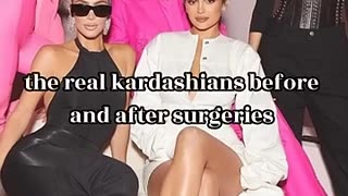 Shocking: kardashians before and after surgery #shorts #edit #kardashian #kylie