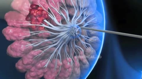 Breast Cancer Biopsy Procedure (3D Animation)
