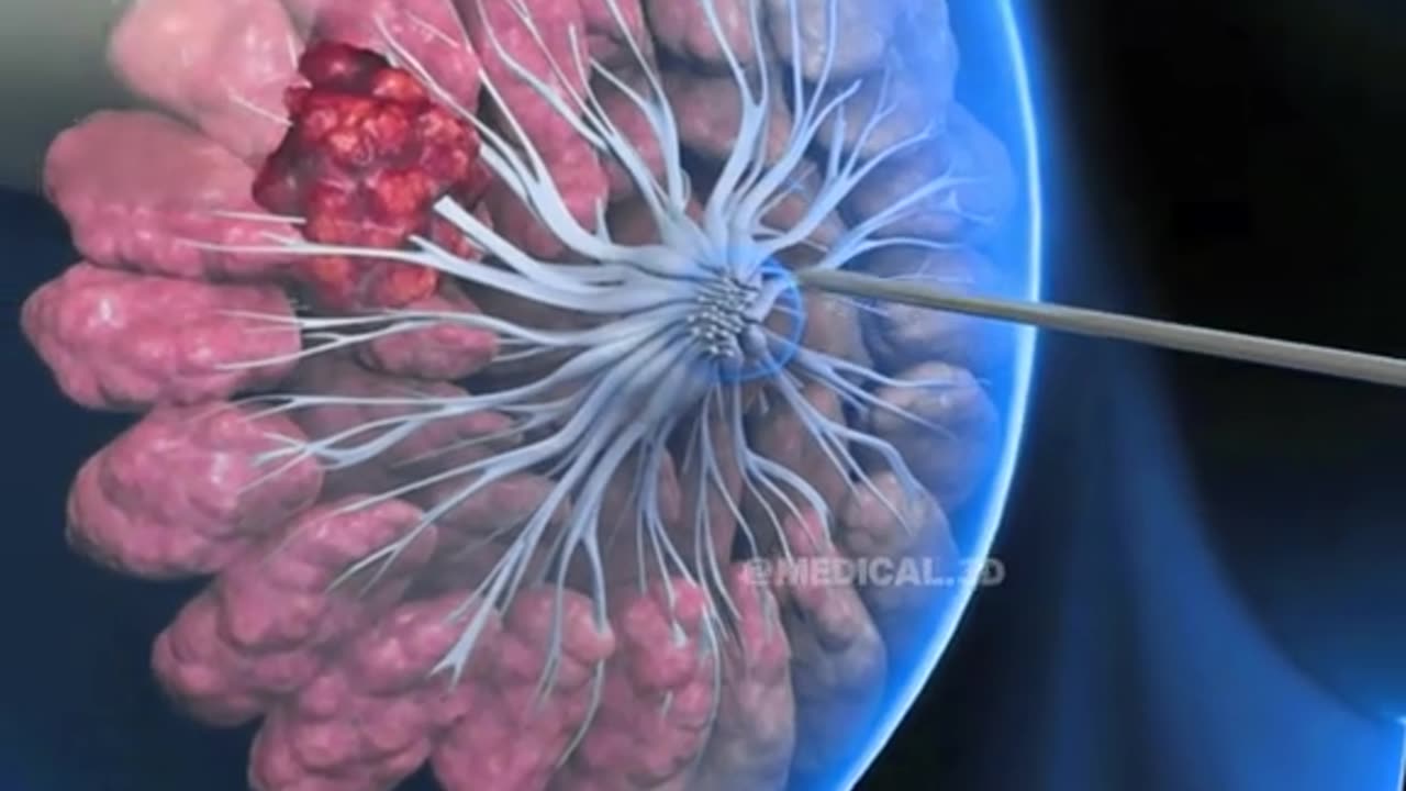Breast Cancer Biopsy Procedure (3D Animation)