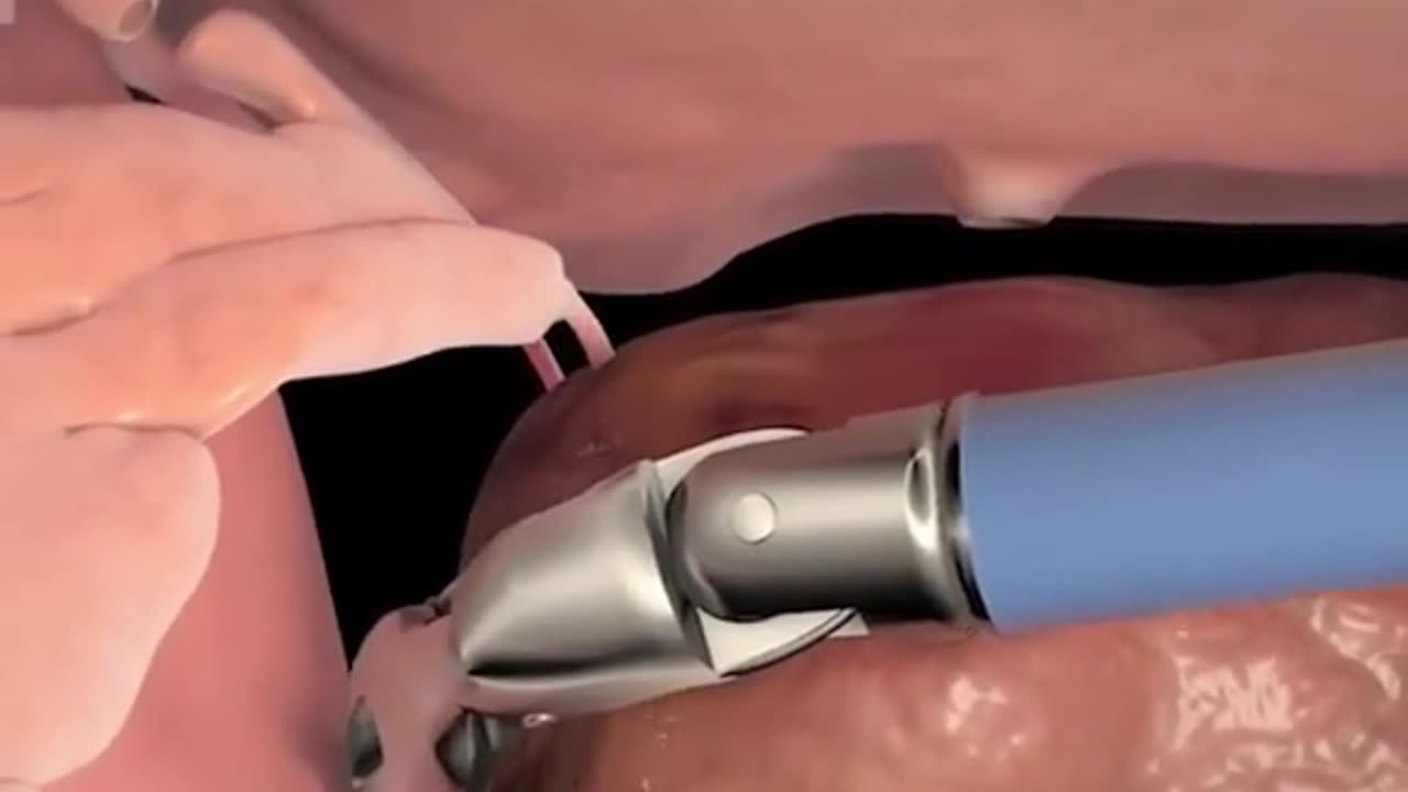 Robot Assisted Prostatectomy Surgery 3D Animation