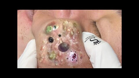 blackhead removal and Pimplepopper Spa relaxation #10112