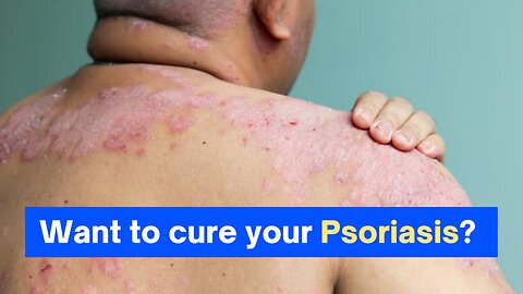 Want to cure your Psoriasis?