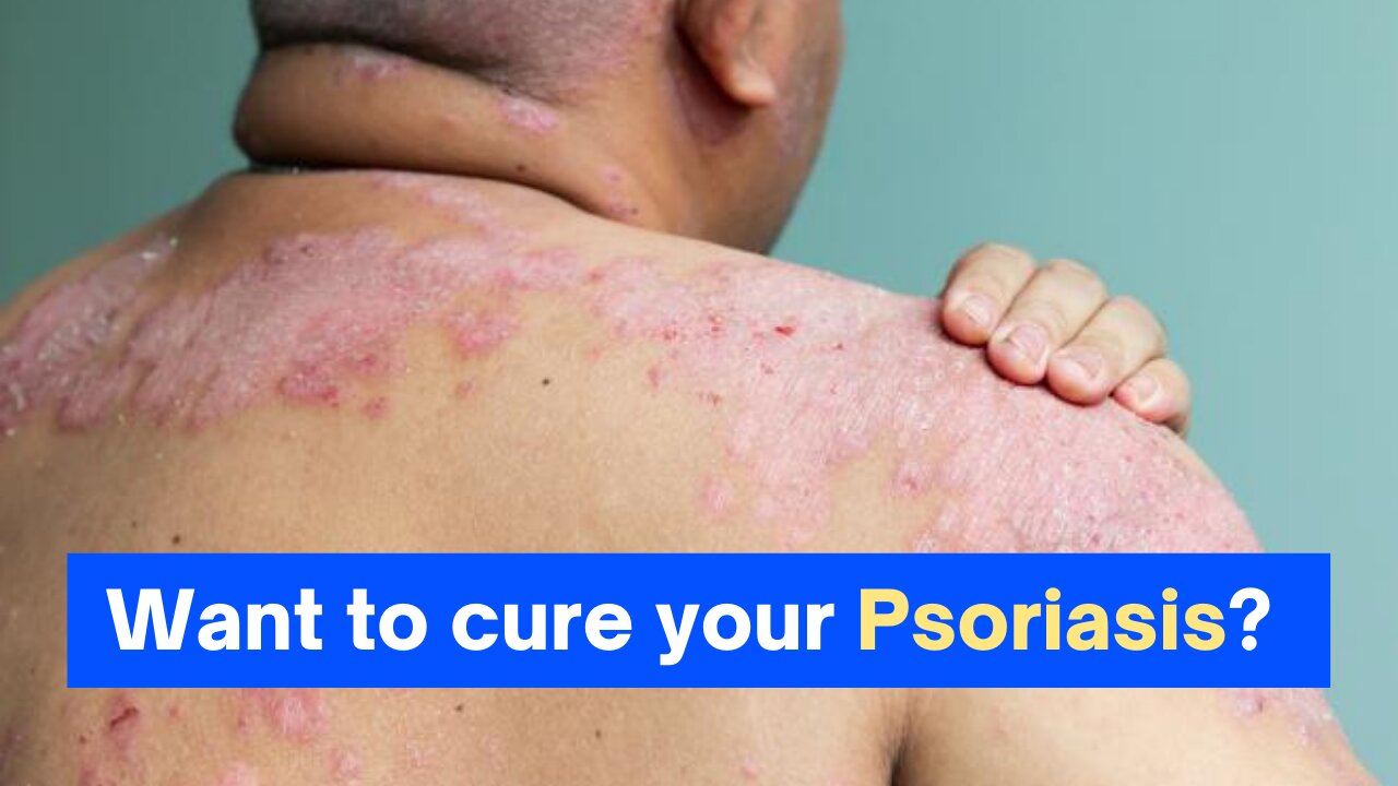 Want to cure your Psoriasis?