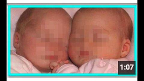 "Twin Infants Die in Suspected Simultaneous Sudden Infant Death Syndrome After Vaccination"