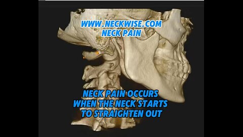 Neck pain and military neck | Neckwise upper cervical chiropractor