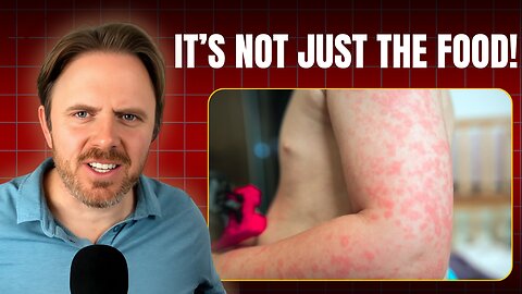 Why You Really Have Food Allergies (Root Cause Revealed)