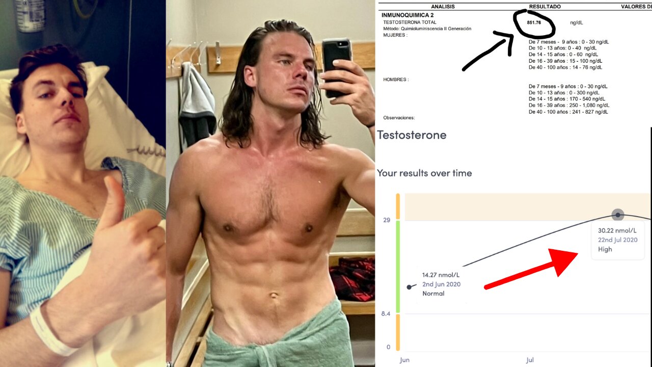 How I Beat Testicular Cancer and Doubled My Testosterone to 865 ng/dL in 90 Days Without TRT.